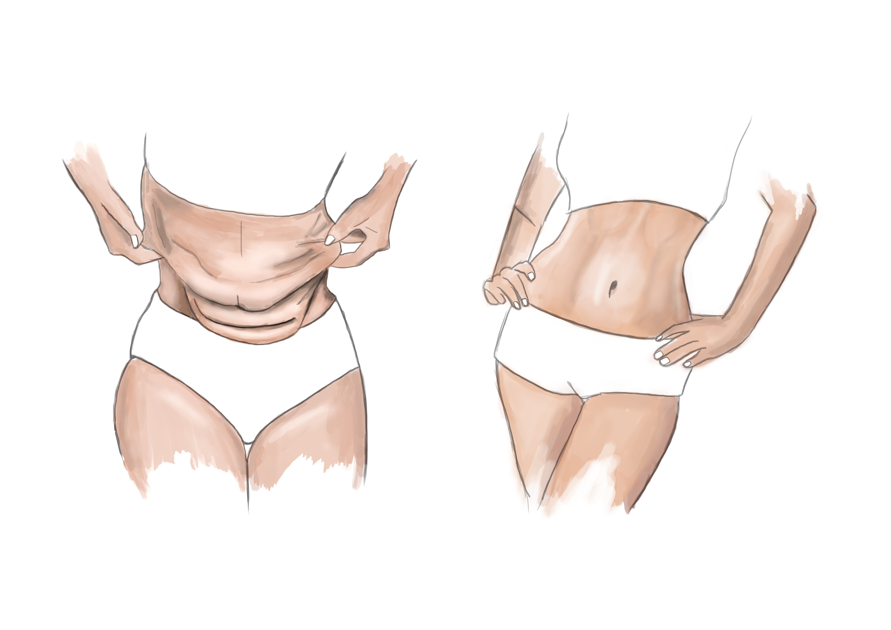 Tummy Tuck, Abdominoplasty